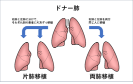 名古屋大学医学部附属病院が肺移植実施施設（国内11施設目）に認定されました ～8月初旬より名大病院で適応評価、待機登録、肺移植手術が可能になります～