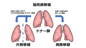 当院初の脳死肺移植を実施しました