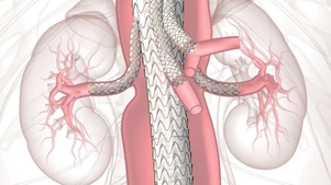 名大病院・血管外科、胸腹部大動脈瘤、傍腎動脈腹部大動脈瘤に対する「4分枝付きステントグラフト（TAMBE）」の保険診療を開始～ 2025年12月2日に第1例目の手術を実施し、成功 ～