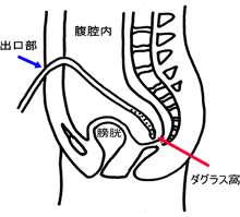 B-8 Q&amp;A腹膜透析