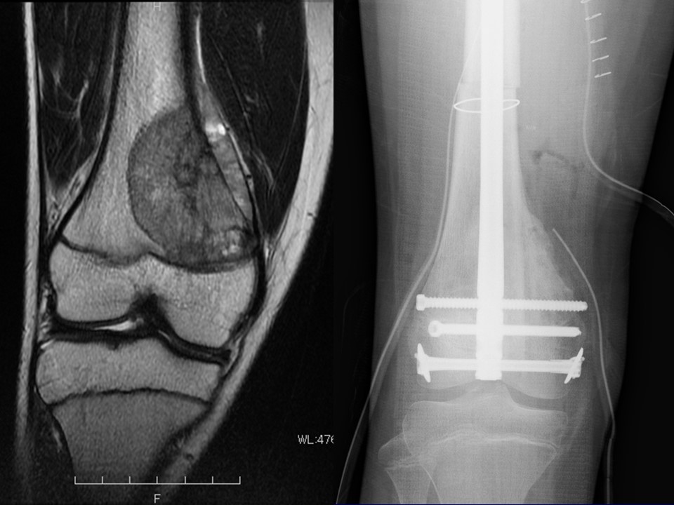 整形外科(大腿骨骨肉腫)