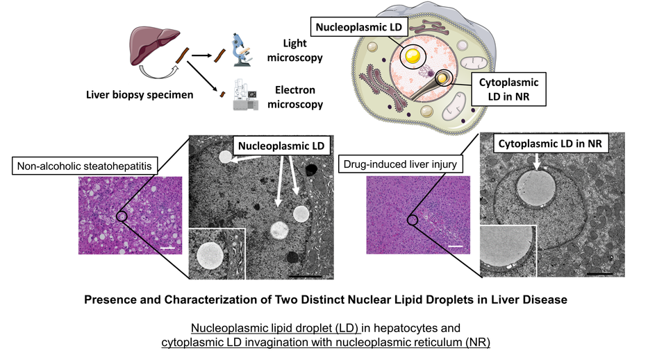 Presence and Characterization of Two Distinct Nuclear Lipid Droplets in Liver Disease
