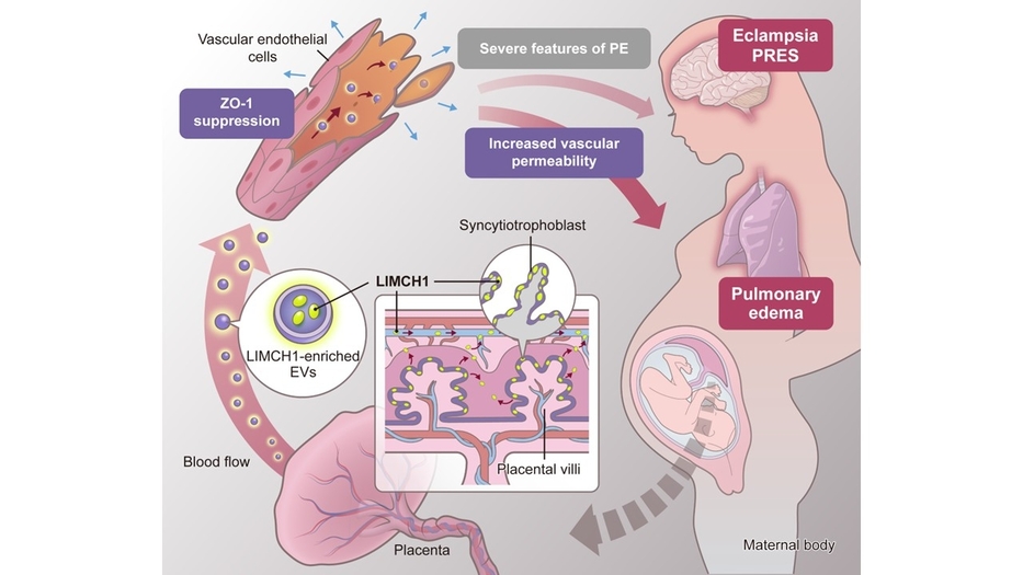 LIMCH1-enriched extracellular vesicles promote vascular permeability in early-onset preeclampsia