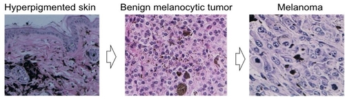 Fig1melanoma.jpg