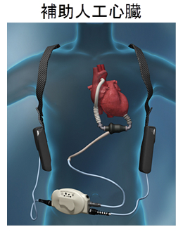 補助人工心臓