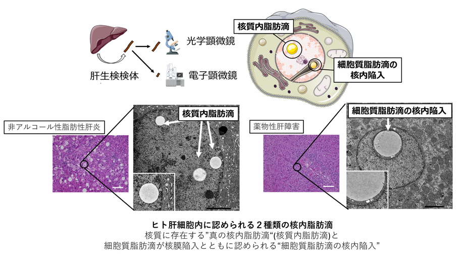 肝疾患における２つの異なる核内脂肪滴の存在と特徴を明らかに