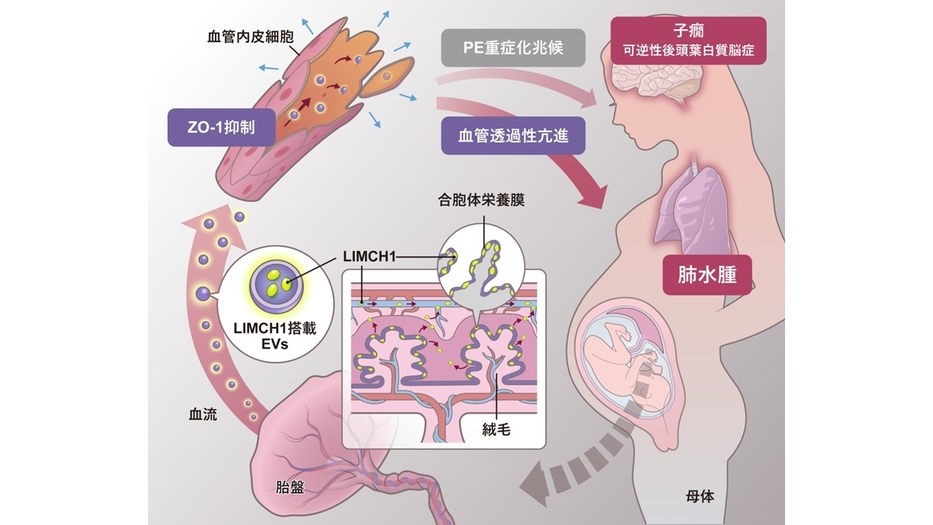 早発型妊娠高血圧腎症の新たな病態メカニズムを解明 -胎盤由来細胞外小胞による血管透過性亢進-