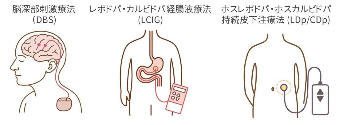 デバイス補助療法