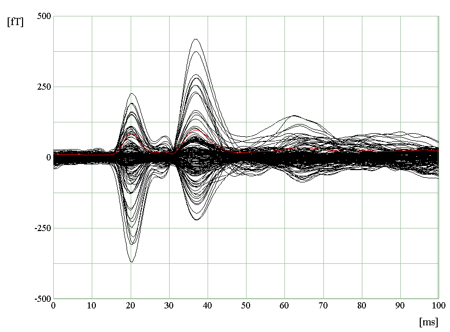 単発の刺激時の脳の反応（右）と第1波（中央）、第2波（左）の電流推定関