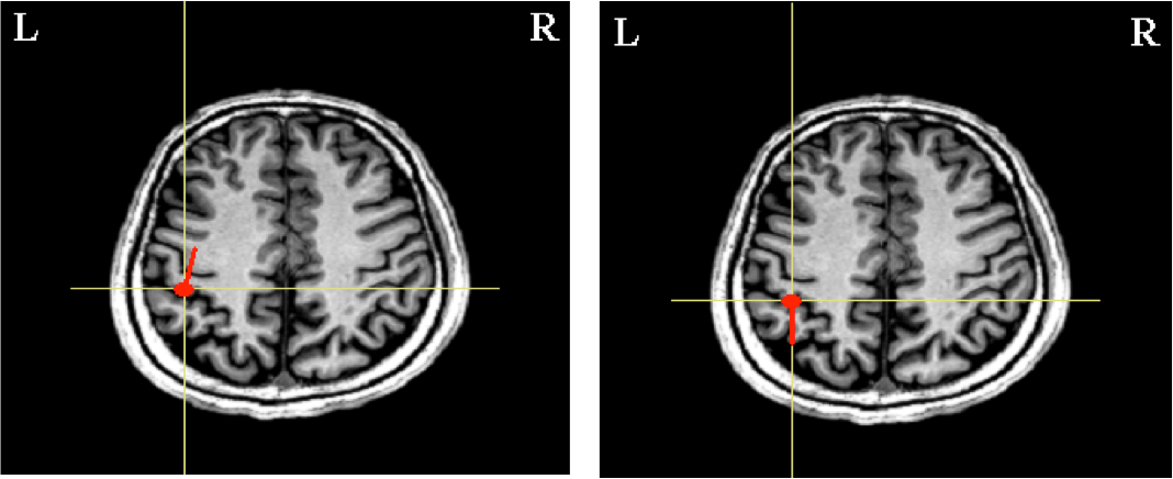 単発の刺激時の脳の反応（右）と第1波（中央）、第2波（左）の電流推定