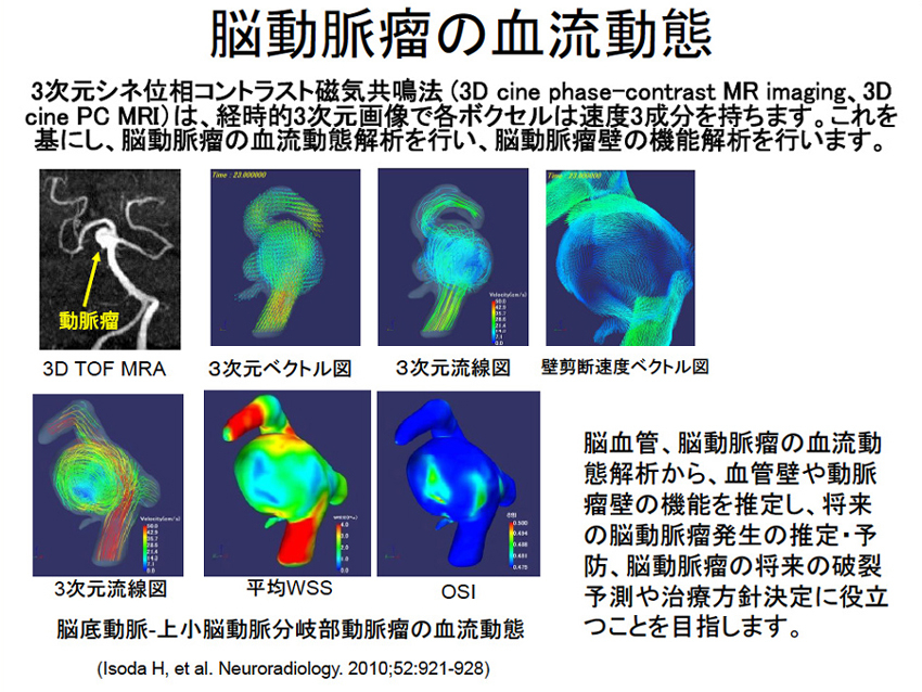 脳動脈瘤の血流動態