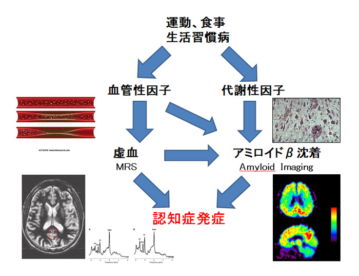 生活習慣病とアルツハイマー型認知症