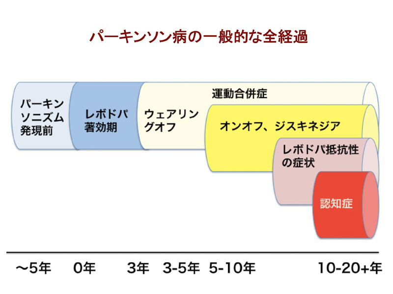 パーキンソン病の一般的な全経過