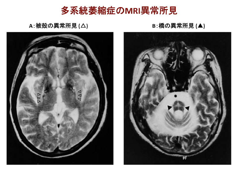 発達障害 統合失調症 鑑別