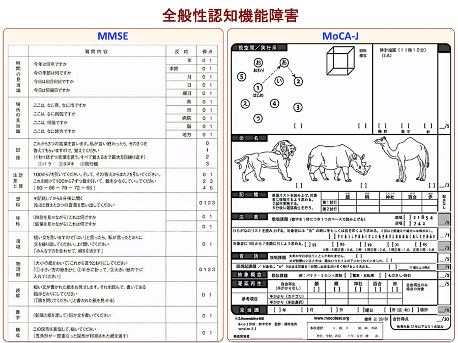 全般性認知機能障害