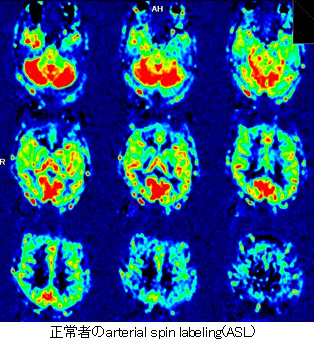 MR perfusion