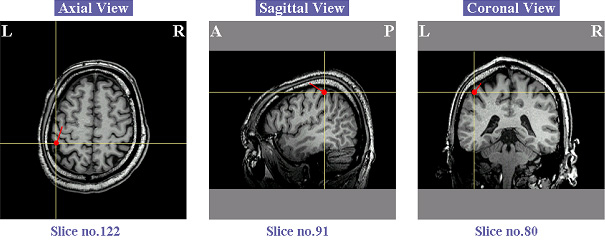 MRI画像上での電流源推定（左半球の手の感覚野・左３つ）