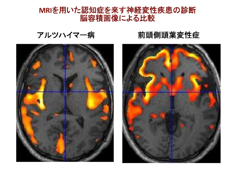 脳とこころの病気について 脳とこころの研究センター
