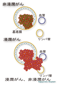 悪性｜乳腺｜名古屋大学医学部附属病院 乳腺・内分泌外科