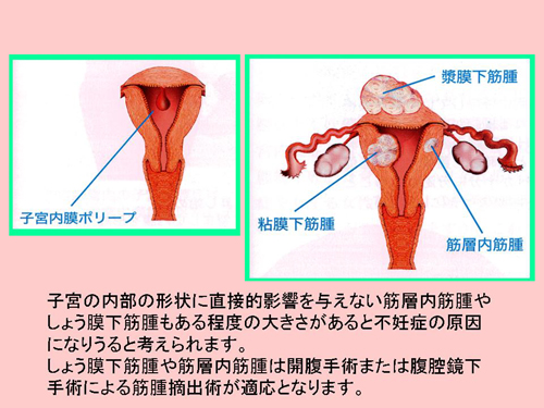 子宮 内 膜 ポリープ