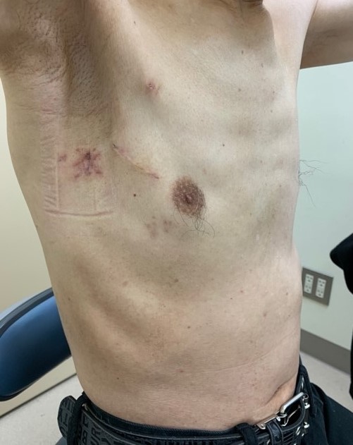 50代男性　僧帽弁形成術後