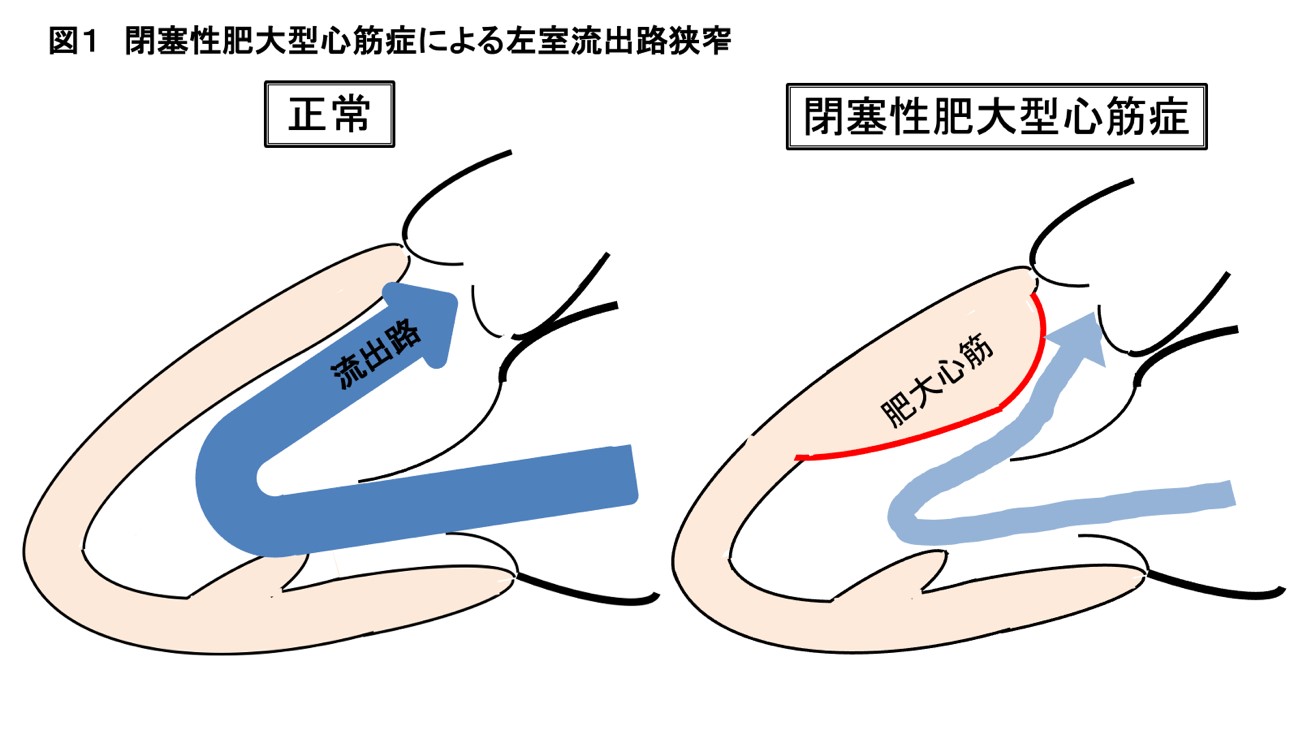 閉塞性肥大型心筋症 Hocm の手術 名古屋大学附属病院ハートチーム