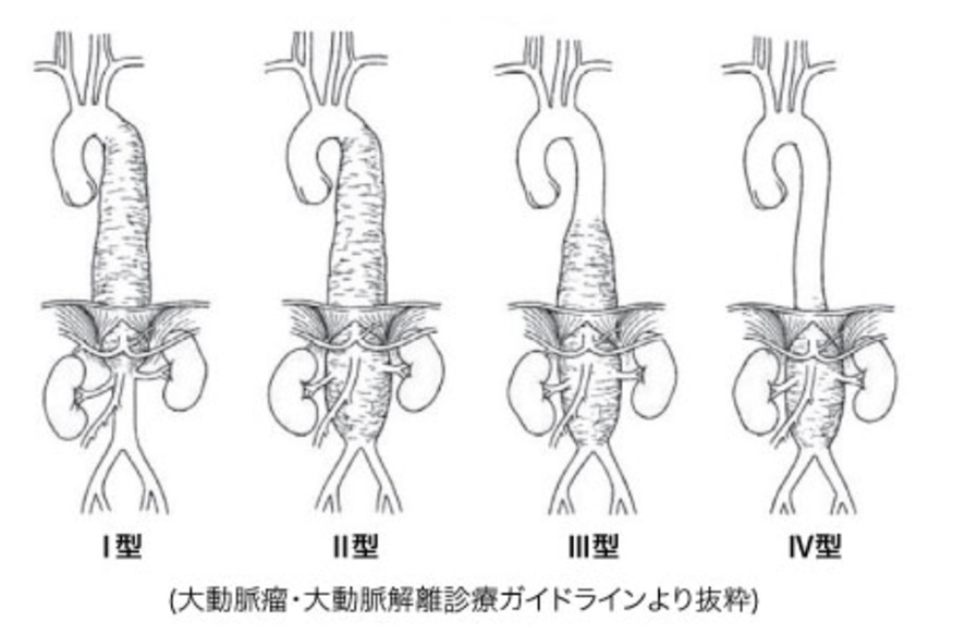 名大病院での胸部大動脈瘤手術 | 名古屋大学附属病院ハートチーム