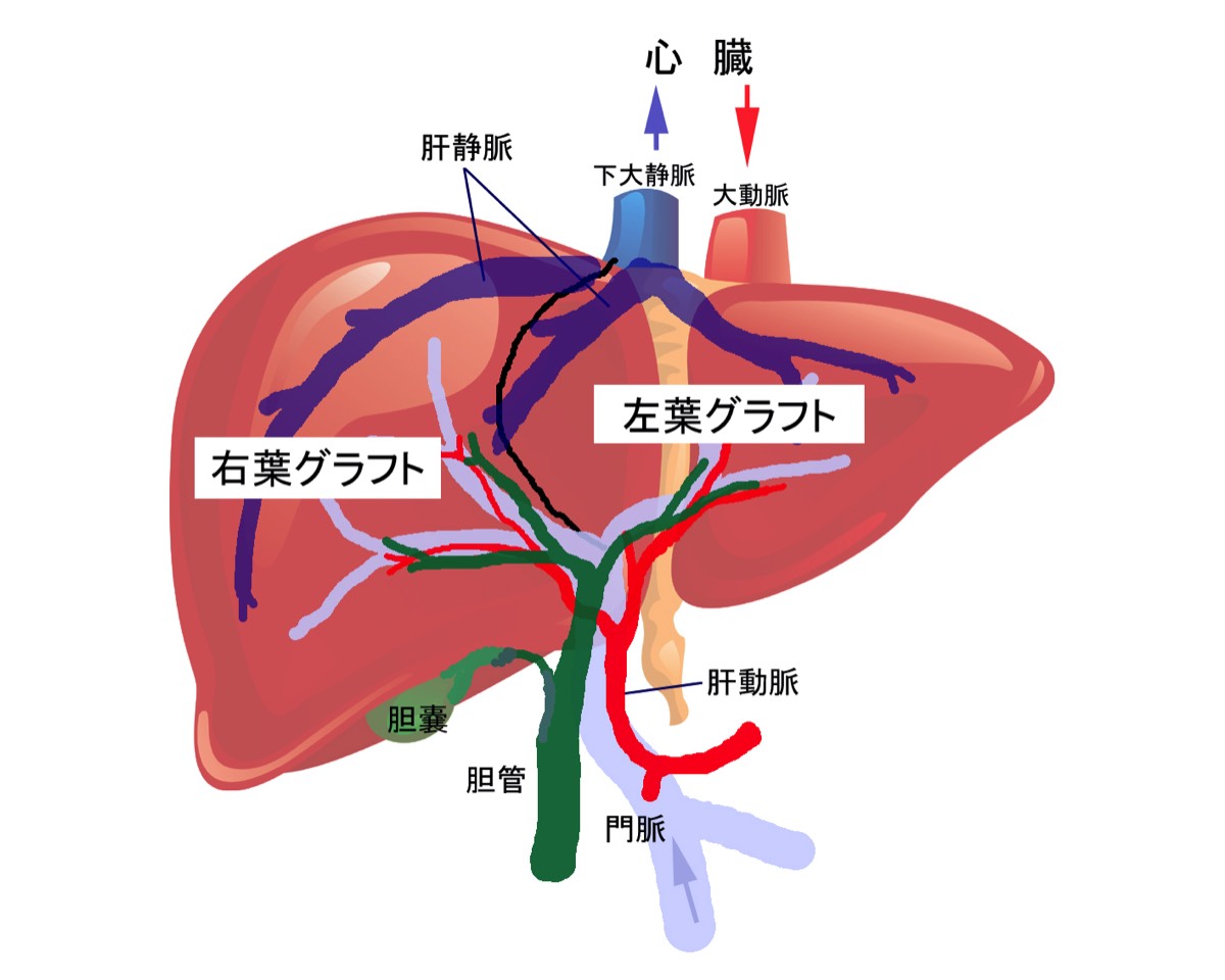 生体肝移植ドナー 名古屋大学医学部附属病院 移植外科