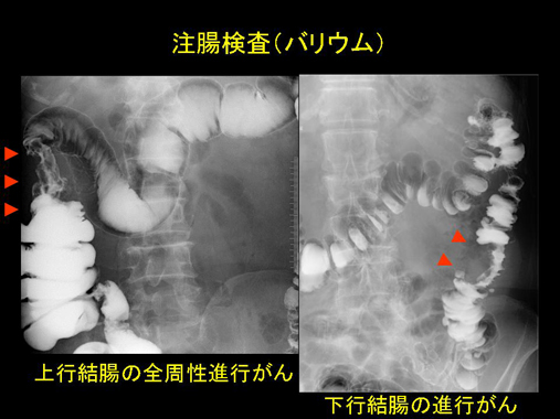 60代以上の勃起不全