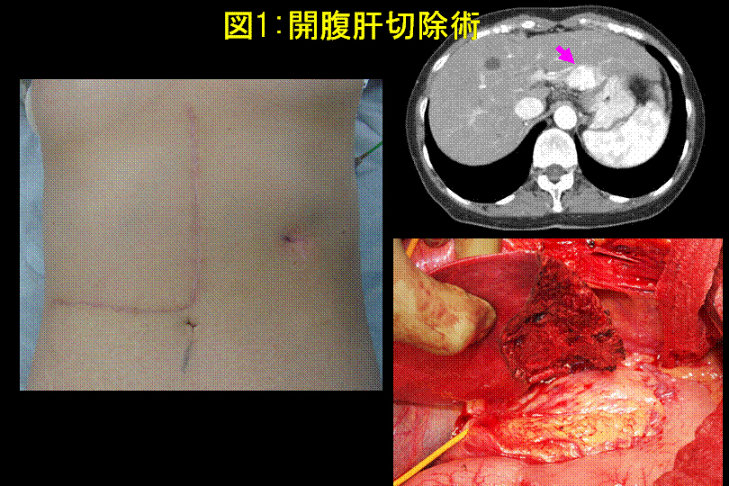 名古屋大学大学院 腫瘍外科学 患者様への診療案内 先端医療 腹腔鏡下肝切除術